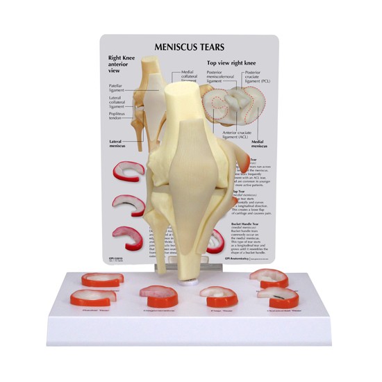 Meniscus Knee - 6 Tears Meniscus Knee - 6 Tears