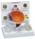 Cataract Eye 280 Cataract Eye 280