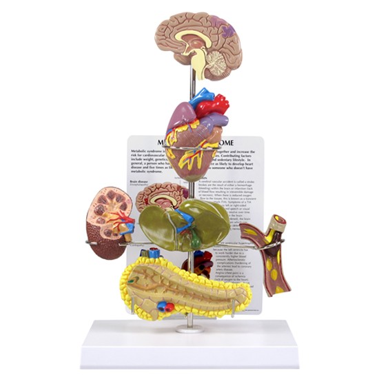 Metabolic Syndrome Metabolic Syndrome